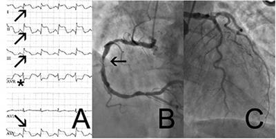 The Brain–Heart Link: A Case Report of a Critically Located Multiple Sclerosis Lesion in the Brainstem Leading to Recurrent Takotsubo Syndrome